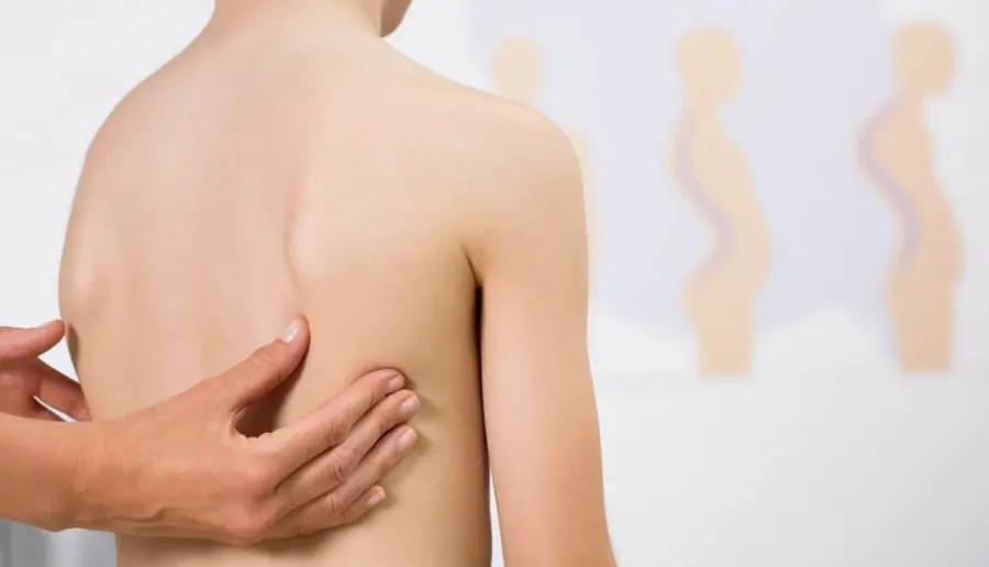 La scoliosi nei bambini