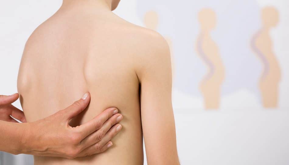 La scoliosi nei bambini