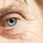 La Cataratta dell'occhio