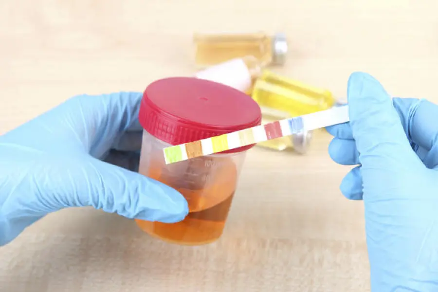 Il Bruciore urinario